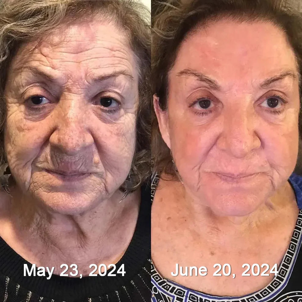 BOTOX BEE VENOM REJUVENECE Y CURA
