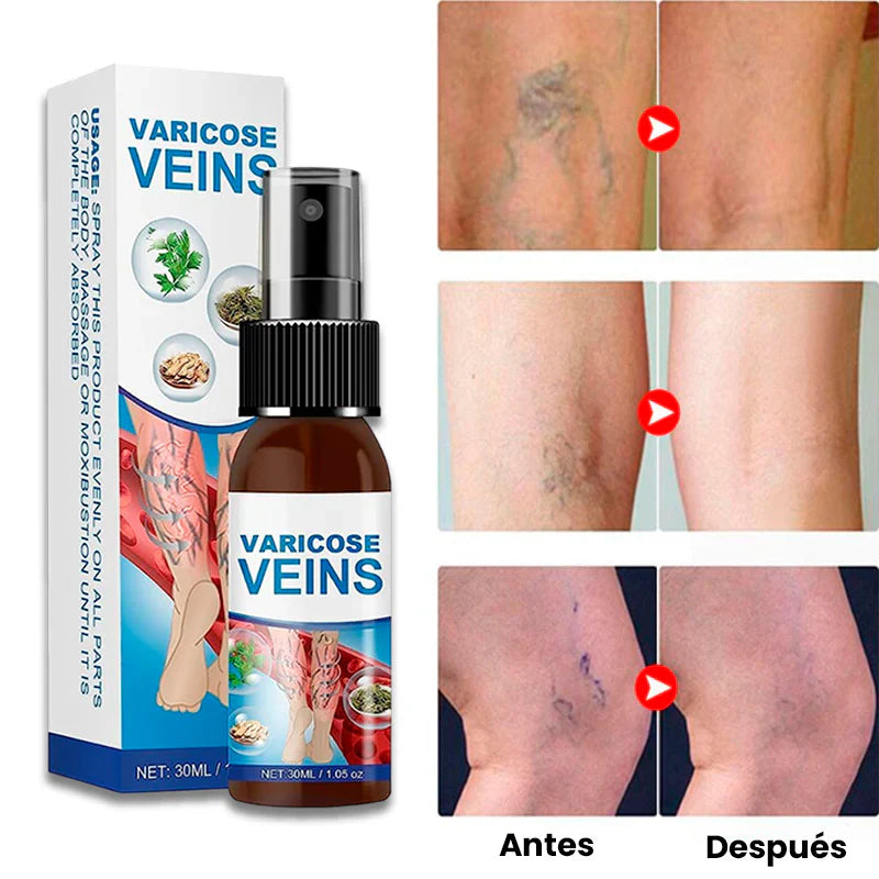 Superior Varicose Veins Spray | Piernas ligeras y sin várices visibles!(Compra 1 unidad +1 GRATIS)