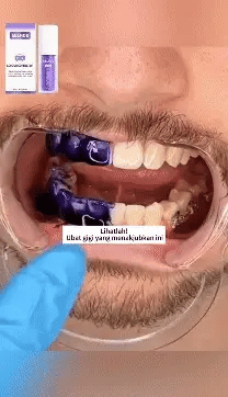 Smilekit-Espuma blanqueadora dental (Compra 1 unidad +1 GRATIS)