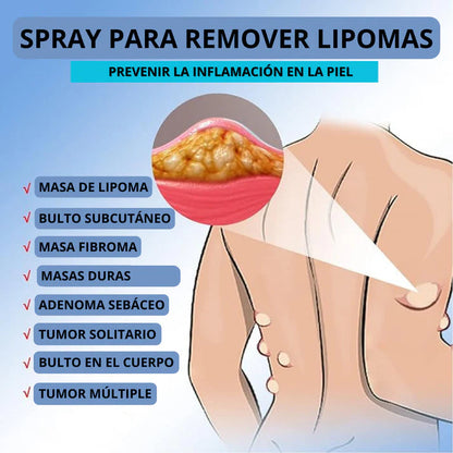 SPRAY ELIMINACIÓN LIPOMA 2x1