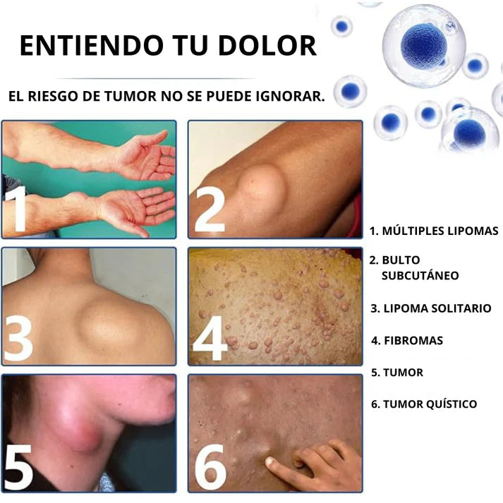 SPRAY ELIMINACIÓN LIPOMA 2x1