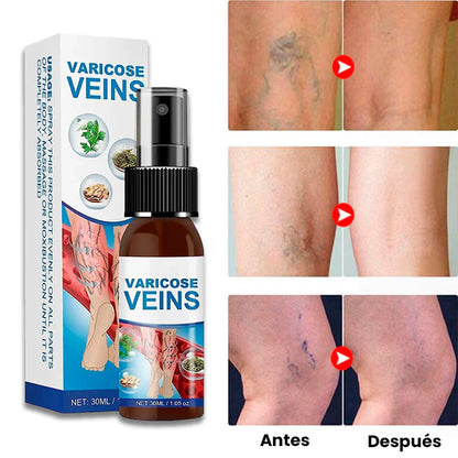 Superior Varicose Veins Spray | Piernas ligeras y sin várices visibles!(Compra 1 unidad +1 GRATIS)